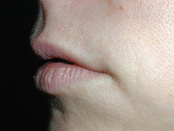 Restylane for upper lip before 100943