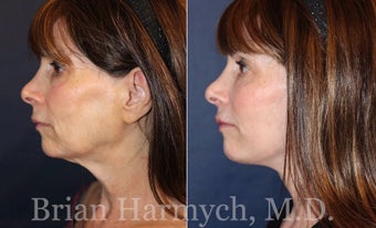 62 year-old female before and 3.5 months after Facelift and Fat Transfer (Autologous Fat Transplant) before 3445872