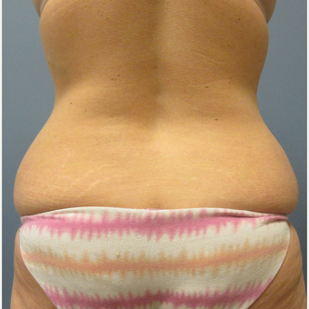45-54 year old woman treated with CoolSculpting before 3763828