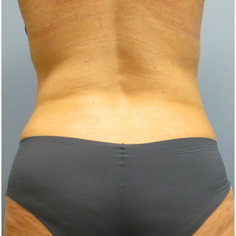 45-54 year old woman treated with CoolSculpting after 3763828