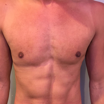 25-34 year old man treated with Male Breast Reduction after 3782490