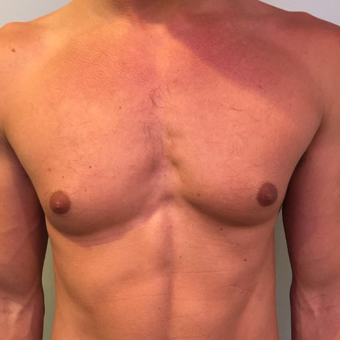 25-34 year old man treated with Male Breast Reduction before 3782490