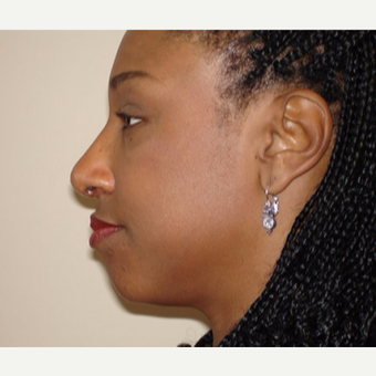 35-44 year old woman treated with Rhinoplasty after 3398846