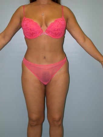 Bikini Tummy Tuck, Liposuction after 242562