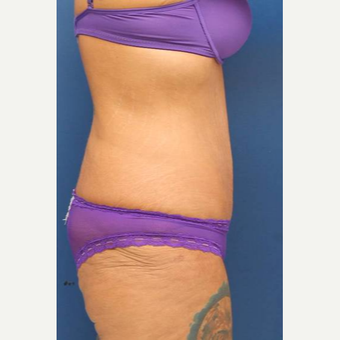 31 year old female, 100 pound weight loss with diet and exercise, had an abdominoplasty (tummy tuck) after 3814752