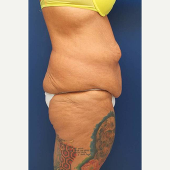 31 year old female, 100 pound weight loss with diet and exercise, had an abdominoplasty (tummy tuck) before 3814752