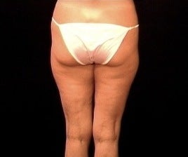 Thighplasty/Body Lift 1092861