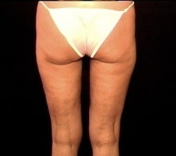 Thighplasty/Body Lift 1092861