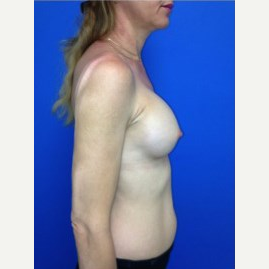 Breast Augmentation after 3744107