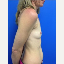 Breast Augmentation before 3744107