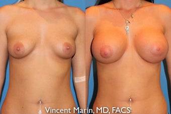 Breast Augmenation before 550556