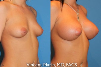 Breast Augmenation after 550556