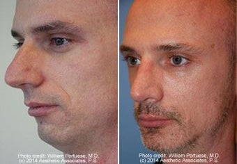 Rhinoplasty, Chin Implant before 91931