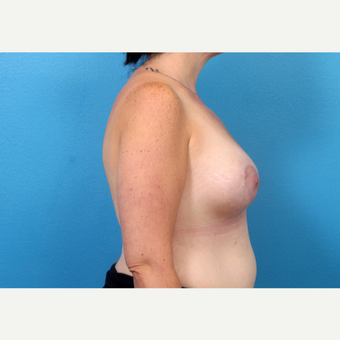 45-54 year old woman treated with Breast Augmentation 3246913