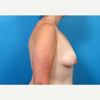 45-54 year old woman treated with Breast Augmentation 3246913