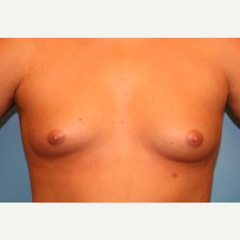 22 year old woman treated with Breast Augmentation before 3482633