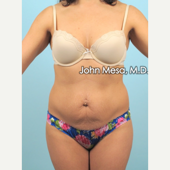 35-44 year old woman treated with Brazilian Tummy Tuck ( Lipo-Abdominoplasty) before 3659766