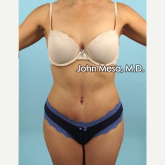 35-44 year old woman treated with Brazilian Tummy Tuck ( Lipo-Abdominoplasty) after 3659766