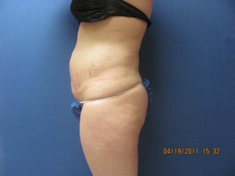 Liposuction of Abdomen and Waist 762370