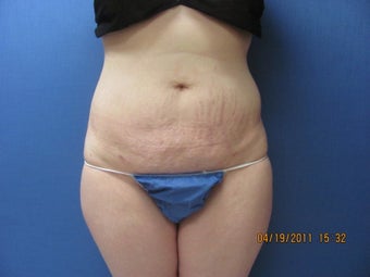 Liposuction of Abdomen and Waist after 762370