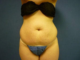 Liposuction of Abdomen and Waist before 762370