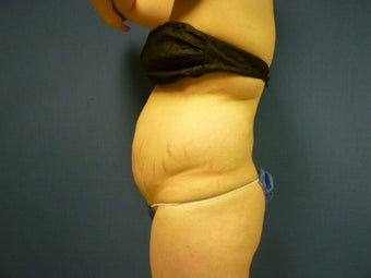Liposuction of Abdomen and Waist 762370