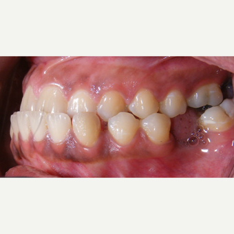 Patient refused surgery and did not want implant or denture for her missing lower left first molar. before 1706892