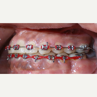 Patient refused surgery and did not want implant or denture for her missing lower left first molar. after 1706892