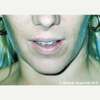 Melasma and Brown Spots treated with Chemical Peel after 1641744