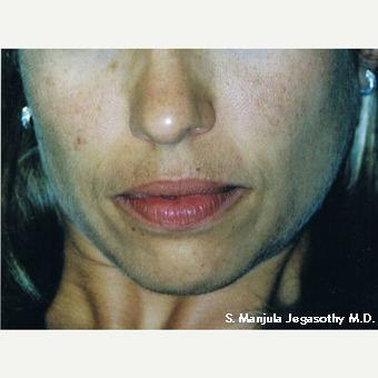 Melasma and Brown Spots treated with Chemical Peel before 1641744