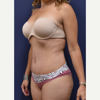 35-44 year old woman treated with Liposuction after 3213954