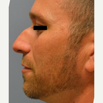 25-34 year old man treated with Rhinoplasty before 3182669