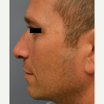 25-34 year old man treated with Rhinoplasty after 3182669