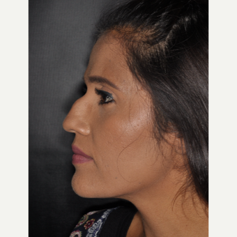 25-34 year old woman treated with Rhinoplasty 10 days post-op before 3452304