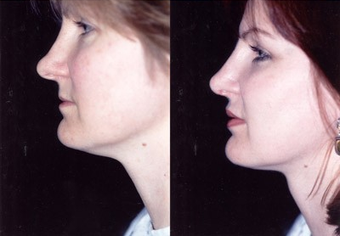 37-year-old woman treated with Facial Fat Transfer. after 574288