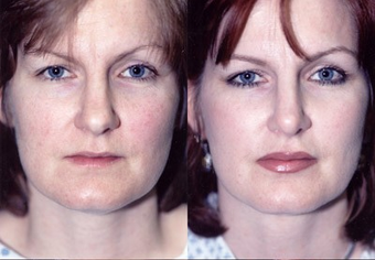 37-year-old woman treated with Facial Fat Transfer. before 574288