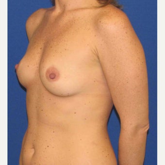 35-44 year old woman treated with Breast Augmentation 1762041