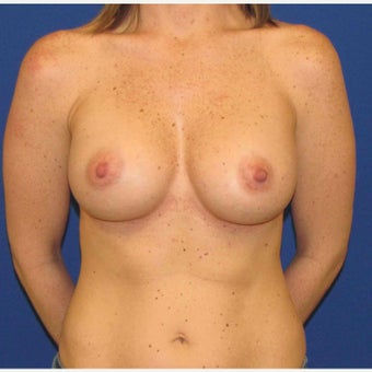 35-44 year old woman treated with Breast Augmentation after 1762041