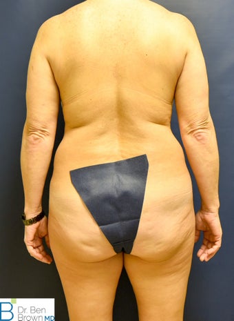 45-54 year old woman treated with Liposuction of the abdomen, flanks and medial thighs. 3486879
