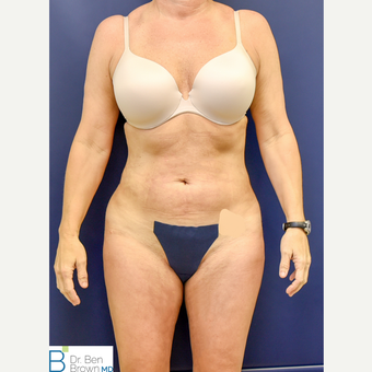 45-54 year old woman treated with Liposuction of the abdomen, flanks and medial thighs. after 3486879