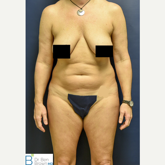 45-54 year old woman treated with Liposuction of the abdomen, flanks and medial thighs. before 3486879