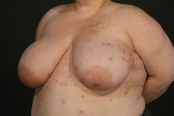 Breast Reconstruction before 927721