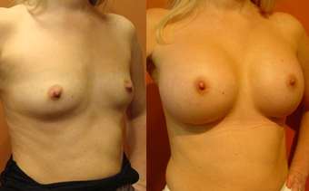 Breast Implants before 974274
