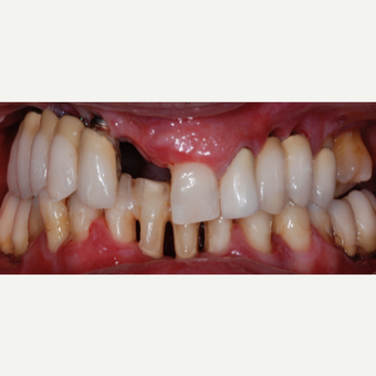 55 year old woman treated with All-on-4 Dental Implants before 2013276