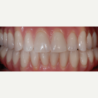 55 year old woman treated with All-on-4 Dental Implants after 2013276