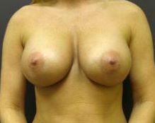 36 year old female with 350 cc high profile silicone breast implants after 665320