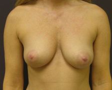 36 year old female with 350 cc high profile silicone breast implants before 665320