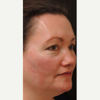 45-54 year old woman treated with IPL after 2838277