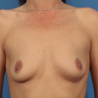 35-44 year old woman treated with Breast Augmentation before 1589910