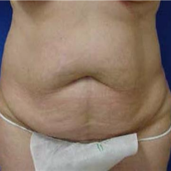 45-54 year old woman treated with Tummy Tuck before 3287813